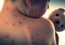 Bangladesh measles outbreak death toll climbs to 499 after 11 more fatalities